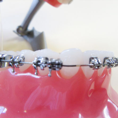 Loose brackets or bands