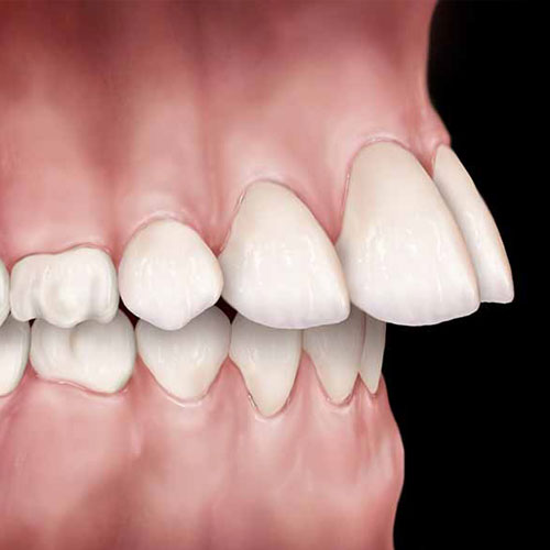 Upper Front</br>Teeth Protrusion