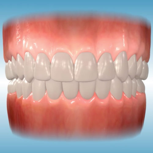 Dental midlines</br>not matched