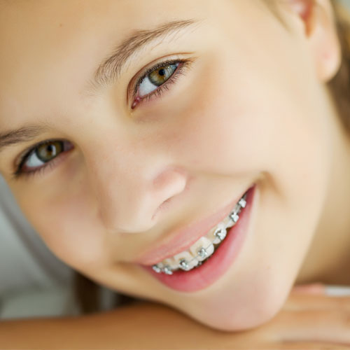 Overbite