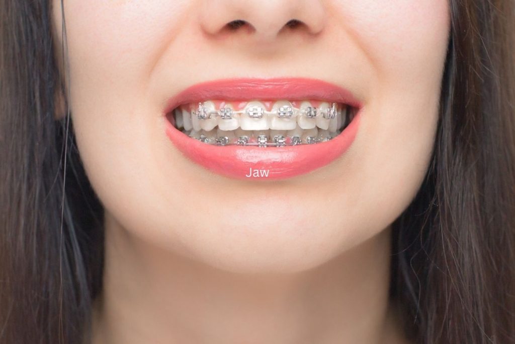 Orthodontic Braces