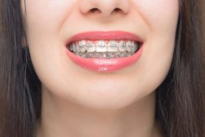 Orthodontic Braces