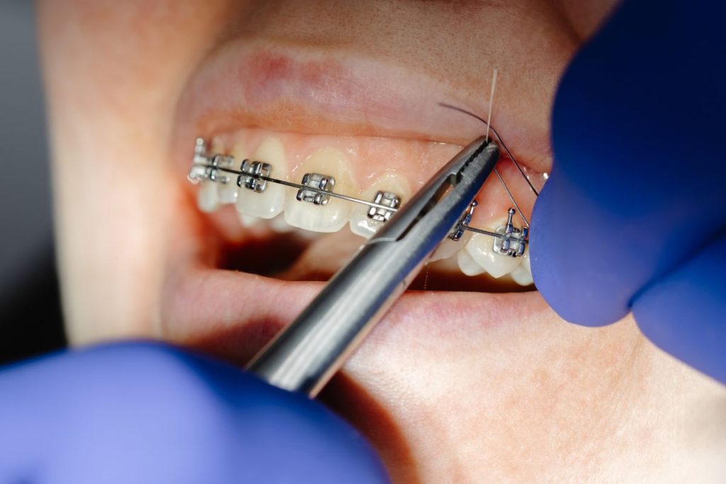 Orthodontic Braces