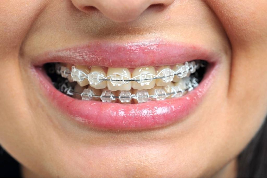 Braces Treatment Process