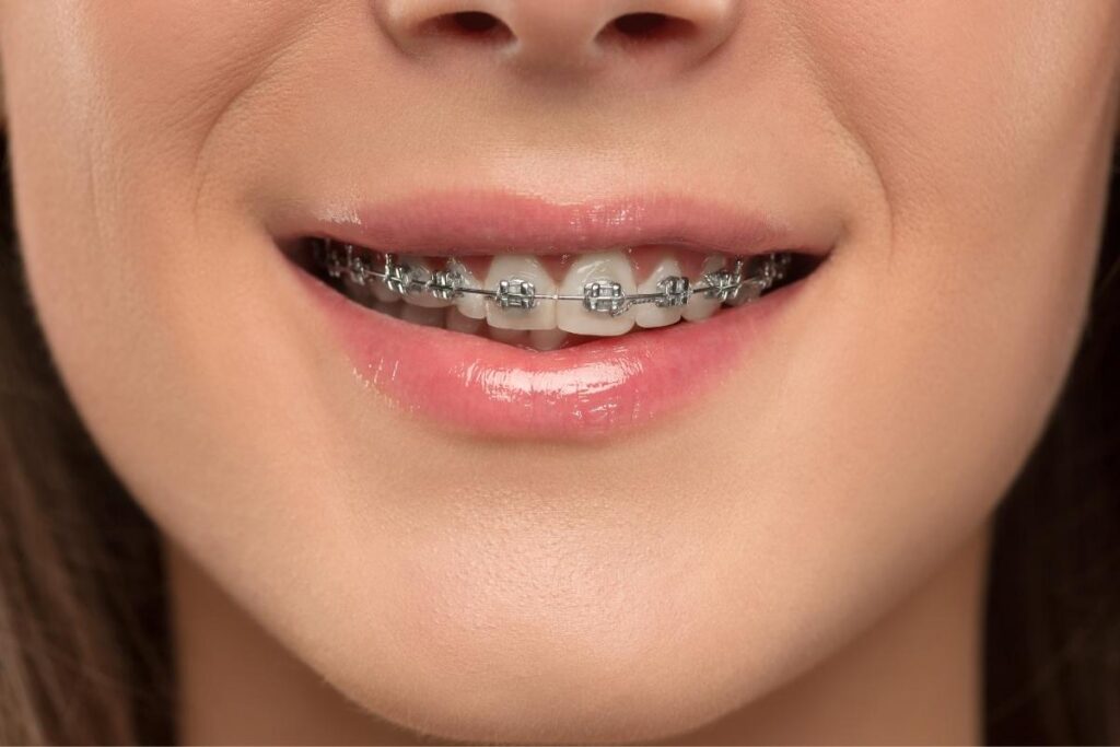 Food Guide for Braces