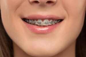Close-up of a patient's smile showing metal braces on upper teeth during orthodontic treatment.