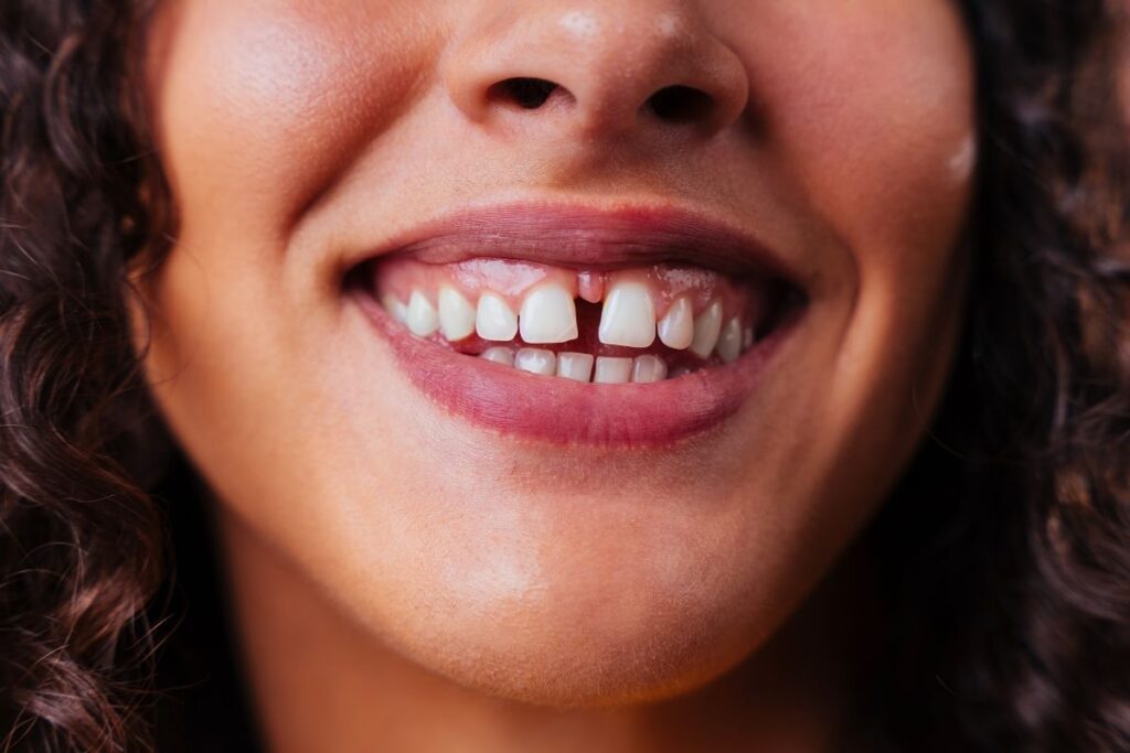 Woman smiling showing teeth with visible gaps between upper front teeth.