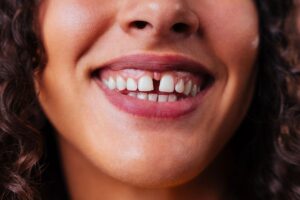 Woman smiling showing teeth with visible gaps between upper front teeth.