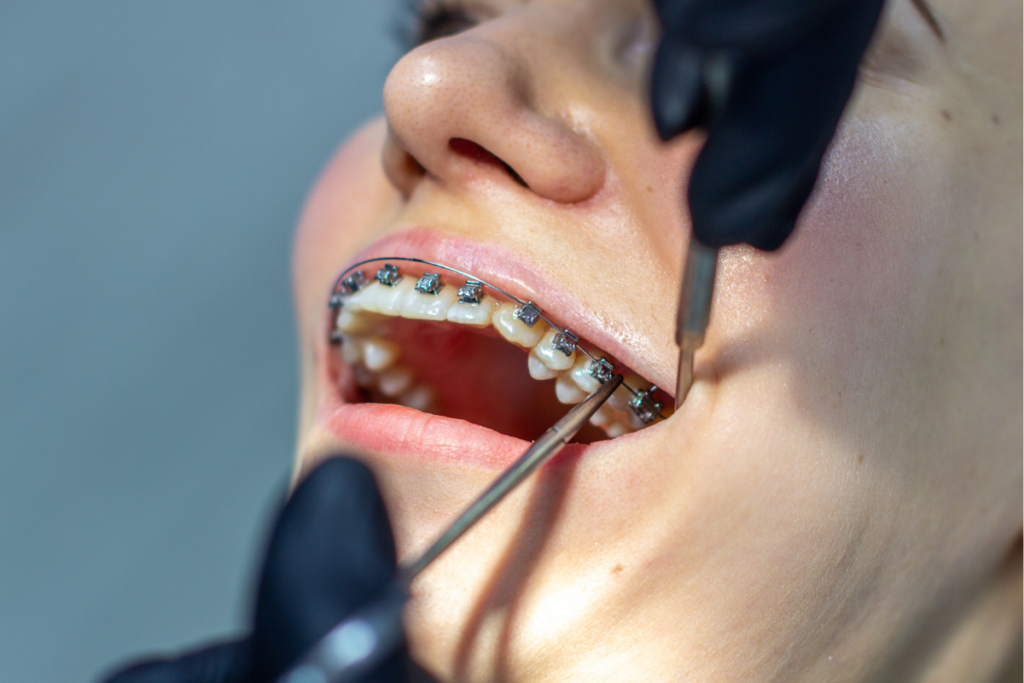 Braces Feel Loose